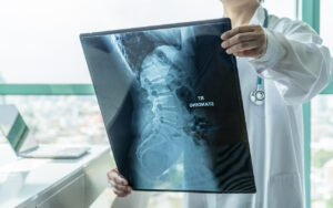 How Medical Errors Lead To Spinal Cord Injuries