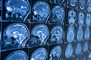 How WGK Personal Injury Lawyers Can Help After a Brain Injury in Maryland